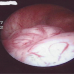 Submucosal fibroid