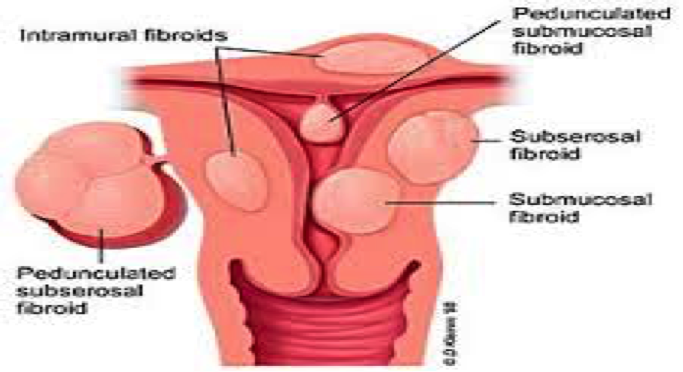 #fibroidproblems