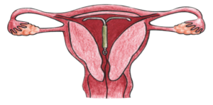 progesterone