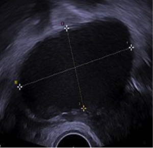 OVARIAN ENDOMETRIOMA