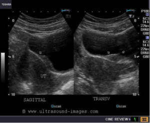 ENDOMETRIOMA IN URINARY BLADDER